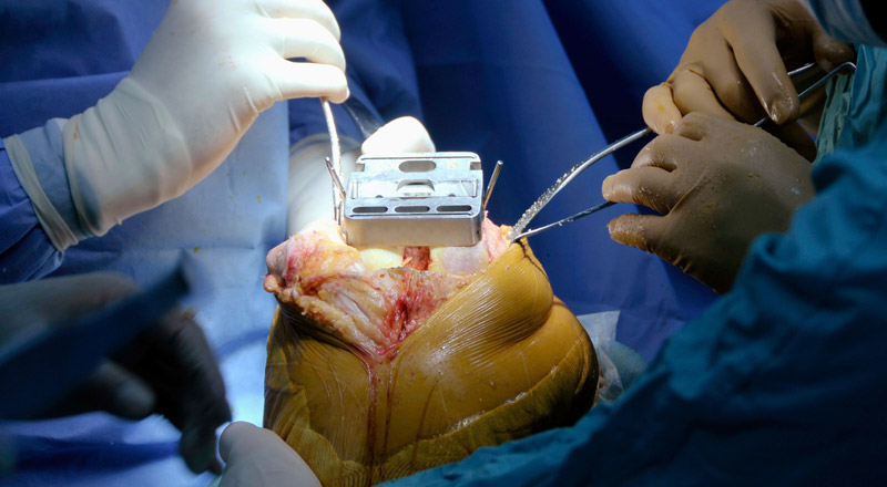 Knee surgery